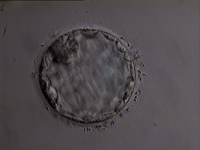 Jelenleg az IVF kezelések során megszületett babák közel 25 %-a iker.