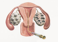 Embriótranszfer, embryovisszaültetés